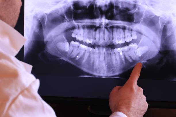 Best Knocked-Out Tooth (Avulsed Tooth) Treatment in Selma, TX