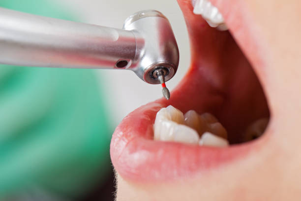 Best Knocked-Out Tooth (Avulsed Tooth) Treatment in Selma, TX